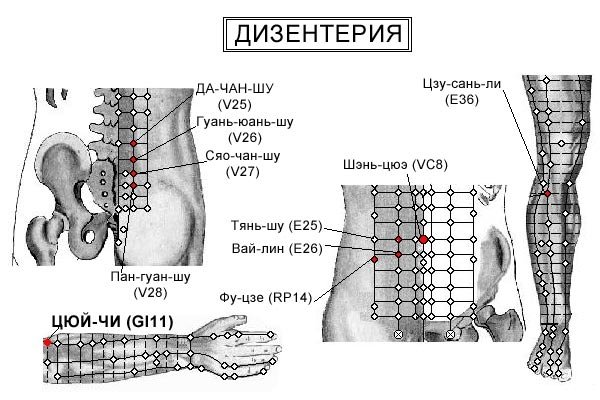 ДИЗЕНТЕРИЯ | ЕЛЕКТРОПУНКТУРА