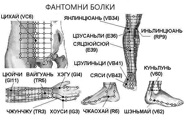 ФАНТОМНИ БОЛКИ | ЕЛЕКТРОПУНКТУРА